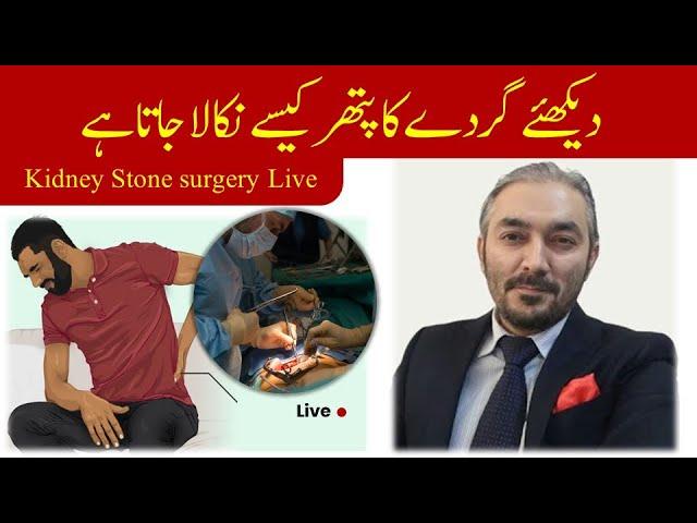 kidneystone surgery/ treatment | guraday ki pathri ka ilaj Urdu/Hindi | Dr Fartash Sarwar