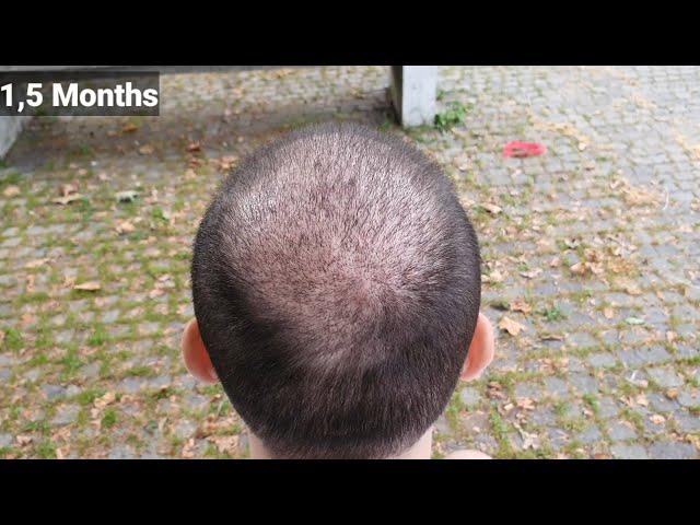 FUE Hair Transplant Timeline I Day 1 to Day 365 I Before & After