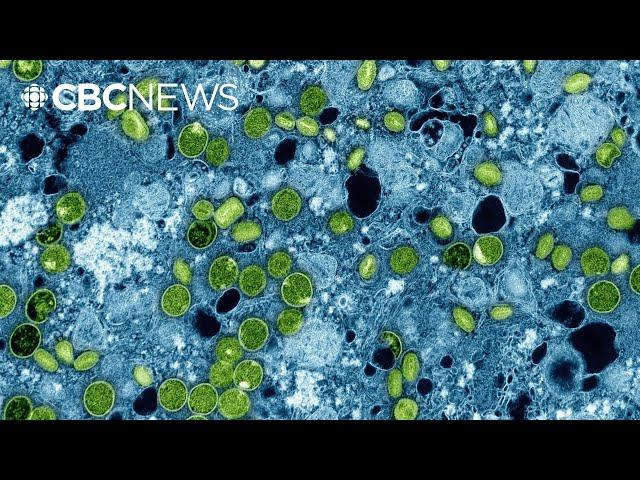 First Canadian case of clade I mpox confirmed in Manitoba