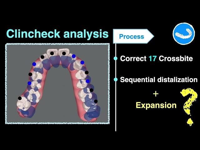 Expansion in Aligners｜【Chris Chang Ortho】CC812