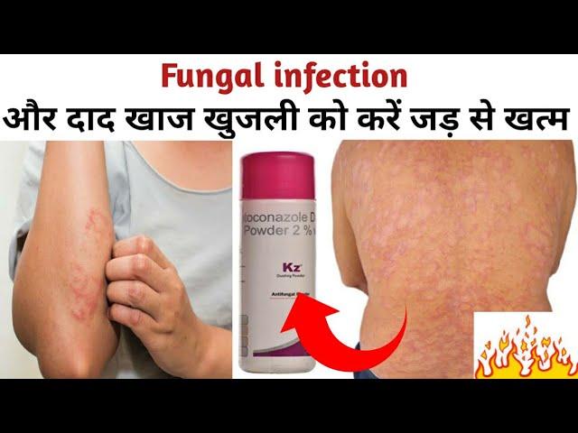 KZ Powder|फंगल इंफेक्शन और दाद खाज खुजली को करें जड़ से खत्म|Anti Fungal Powder For Itching Problem|