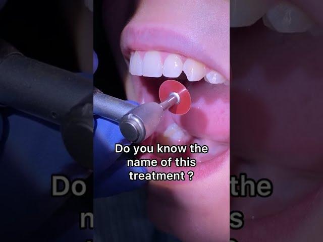 Enameloplasty after Braces - Dental Cosmetic procedure - Tooth Time Family Dentistry New Braunfels