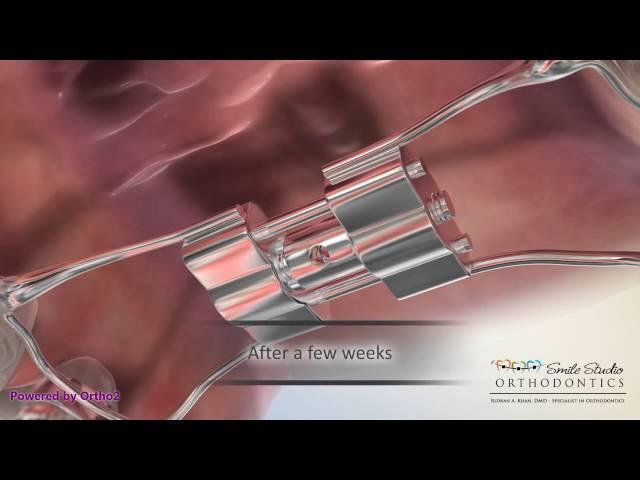 Orthodontic Appliance - RPE (Rapid Palatal Expander)