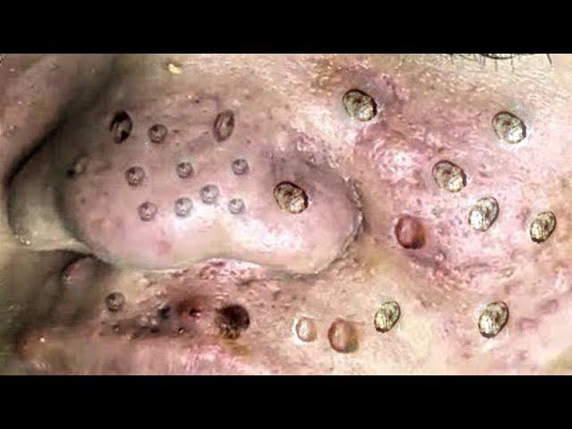 Big Cystic Acne Blackheads Extraction Blackheads & Milia, Whiteheads Removal Pimple Popping #