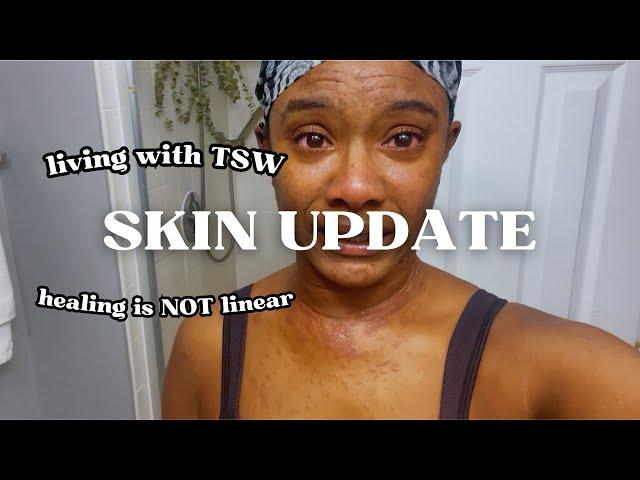 SKIN UPDATE : Eczema Journey & Living w/ TSW