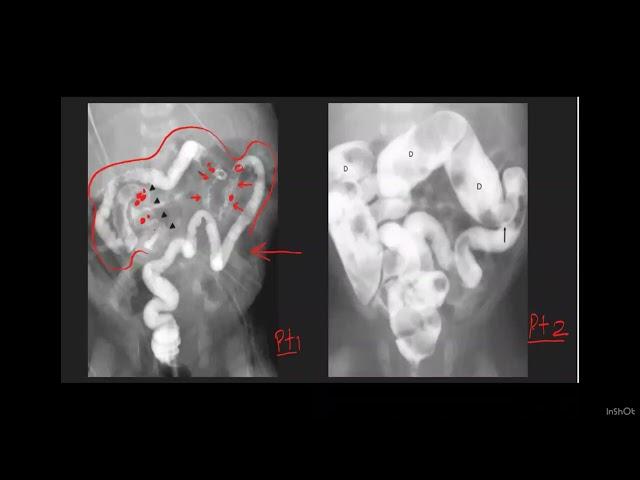 HOW TO APPROACH RADIOLOGICALLY INFANTS WHO  FAIL TO PASS MECONIUM WITH DIFFERENTIALS & CATCH POINT