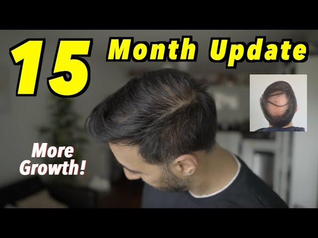 15 Month 2nd Hair Transplant Update | 4000 GRAFTS FUE | MORE GROWTH