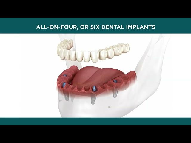 Lorton Springfield Dental Implant & Oral Surgery - All on 4 Dental Implant Treatment