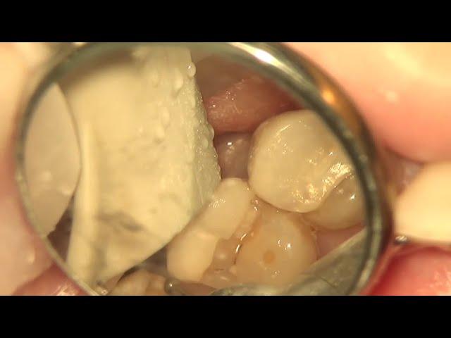 zirconia inlay reduction