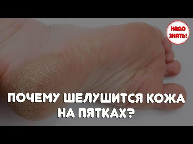 Почему шелушится кожа на пятках?