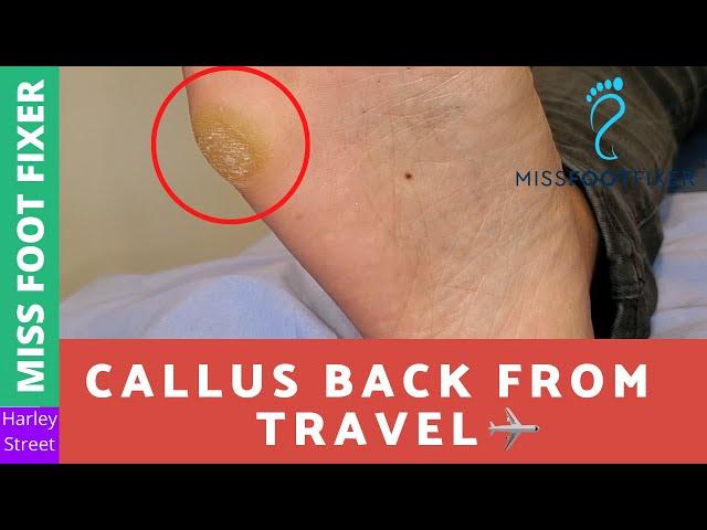 Callus Back From Travel | Miss Foot Fixer | Marion Yau