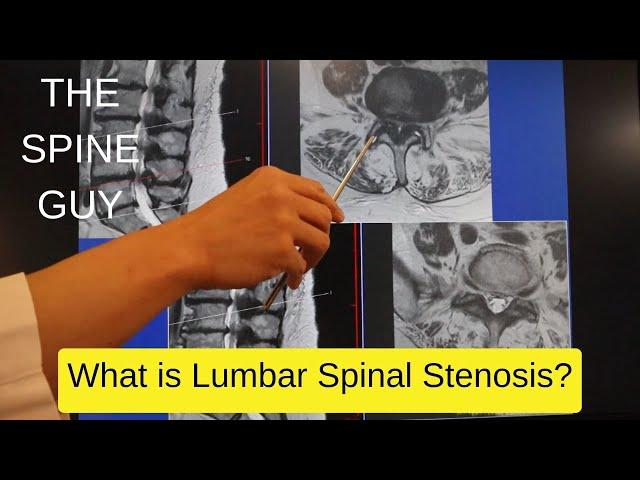 Part 1 - What is Lumbar Spinal Stenosis?