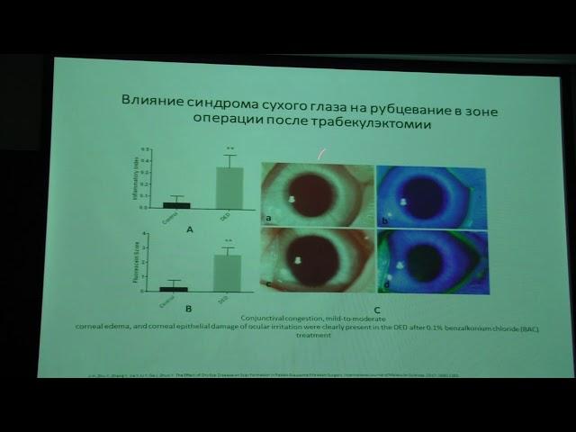 Глаукома и синдром сухого глаза