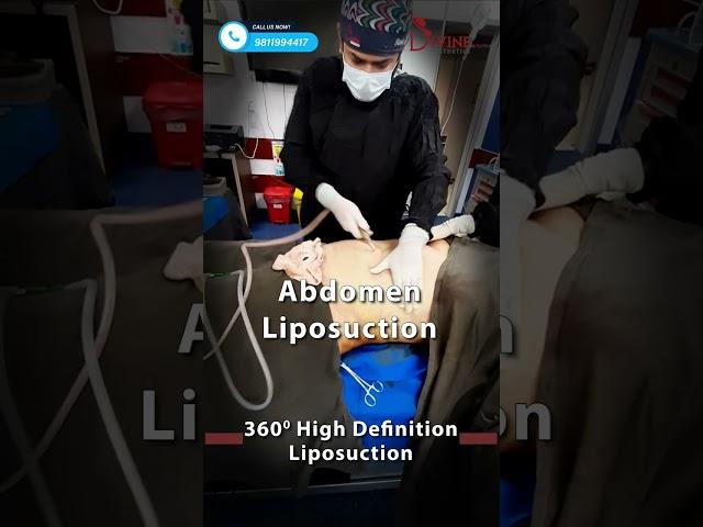 360° High Definition Liposuction | Body Contouring by Liposuction #shorts