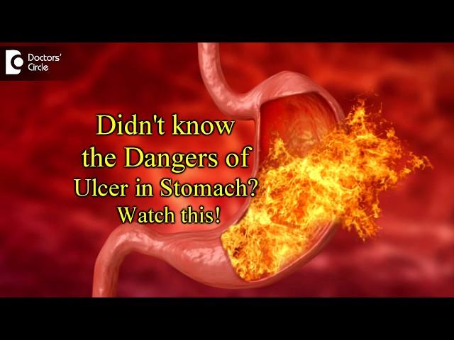 Peptic Ulcer Perforation|Is it life threatening?Symptoms,Treatment-Dr.Nanda Rajaneesh|Doctors Circle