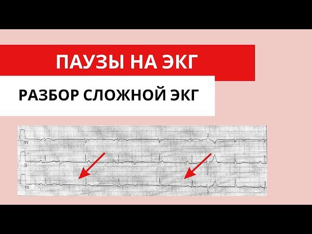 Паузы на ЭКГ. Разбор сложной ЭКГ. Блокированные экстрасистолы.