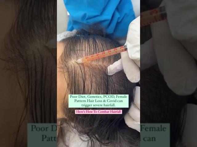 {2024 } PRP - Best hair loss treatment for females #shorts