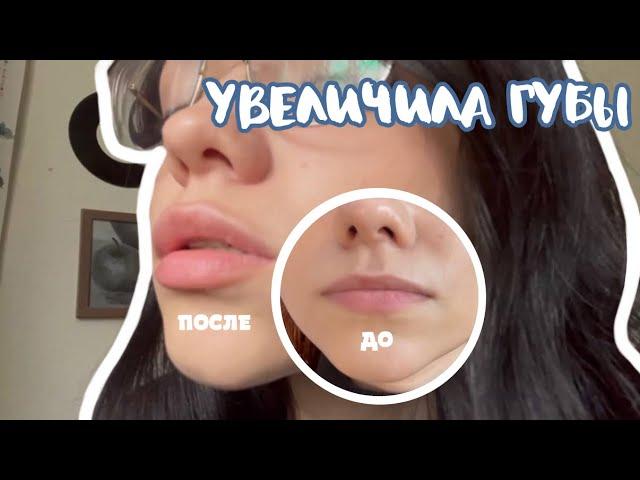 увеличила губы | реакция друзей | результат спустя два месяца