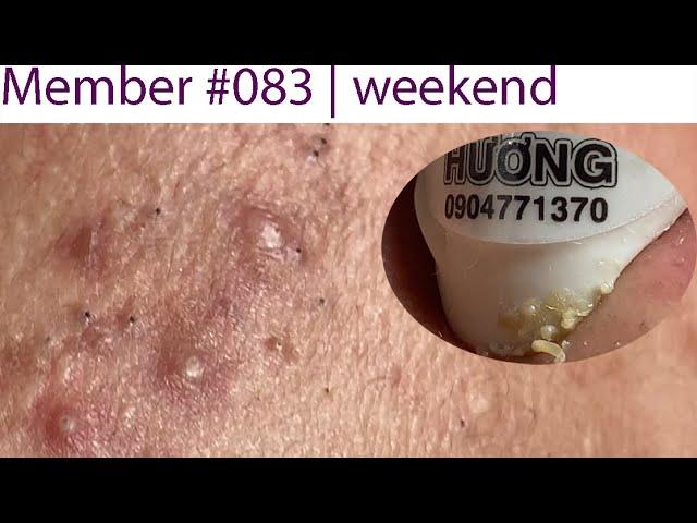 Acne Treatment Huong Da Nang# 083 | Member