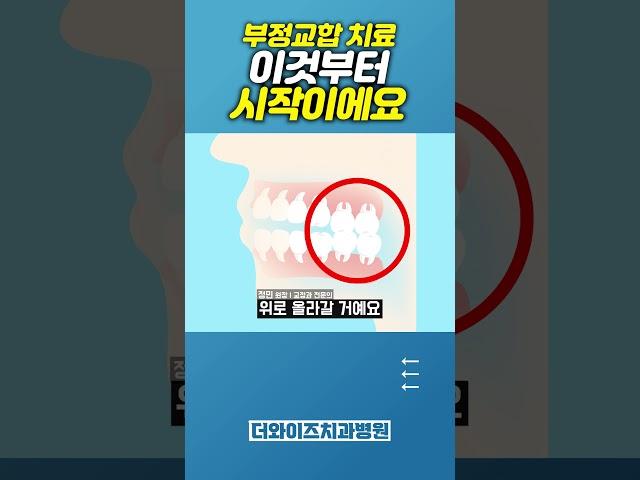 부정교합 치료 간단 정리... #치과의사 #치료 #dentist #치아교정