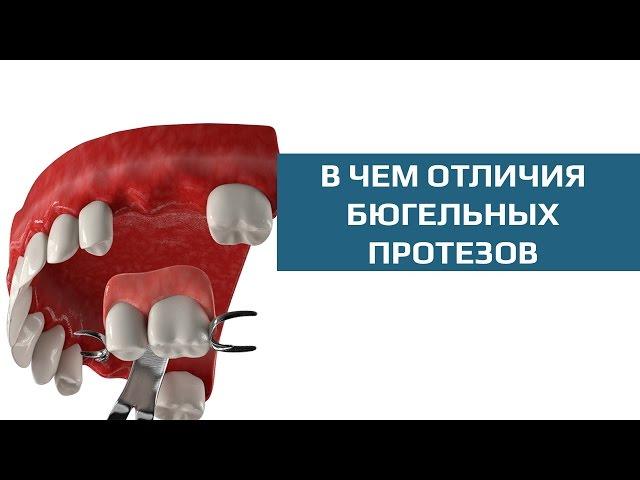 Съемные зубные протезы. Сравнение бюгельных протезов на кламмерах и аттачментах