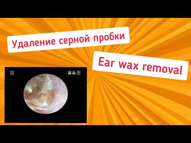 Ear wax removal. Удаление серной пробки.