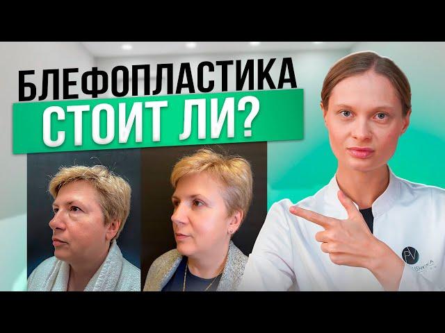 Что Такое Блефаропластика и Как Подготовиться к Операции?