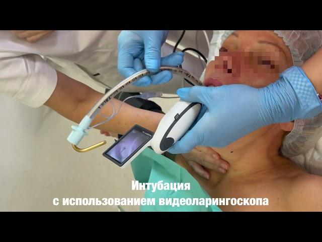 Интубация с использованием видео ларингоскопа