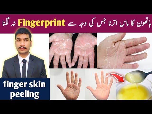 finger skin peeling hathon ka mass utarna