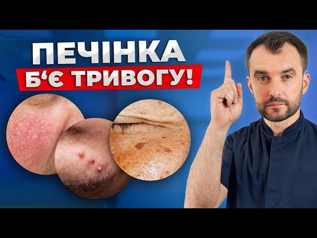 Перші ознаки проблем з печінкою! НЕ ІГНОРУЙ ЦІ СИГНАЛИ!