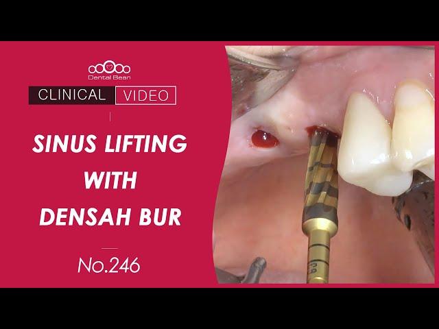 Implant placement & Sinus lifting using Densah bur - [Dr. Kim Yongjin]