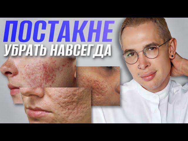 ПОСТАКНЕ как избавиться? Самый ПРАВИЛЬНЫЙ и ЭФФЕКТИВНЫЙ способ #постакне