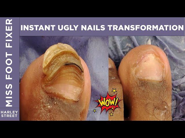 INSTANT UGLY NAIL Transformation By Miss Foot Fixer Marion Yau