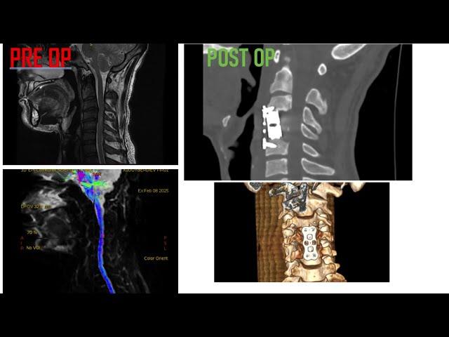 Diagnoz: Og‘ir bo‘yin umurtqalari shikastlanishi. Og‘ir orqa miya kontuziyasi.