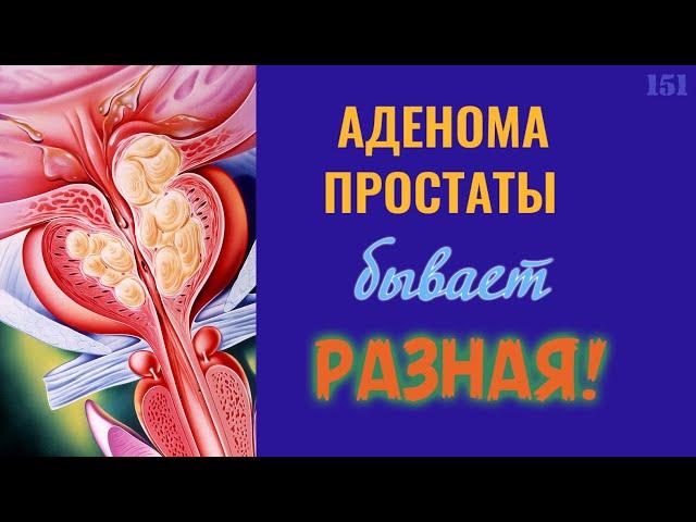 Аденома простаты бывает разная! | Лечение аденомы простаты (ДГПЖ)