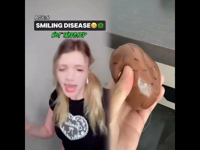 Smiling disease #funny