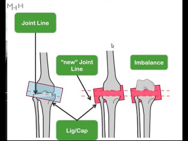 Phenotypic Alignment in TKA