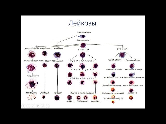 Лейкопении, Лейкозы