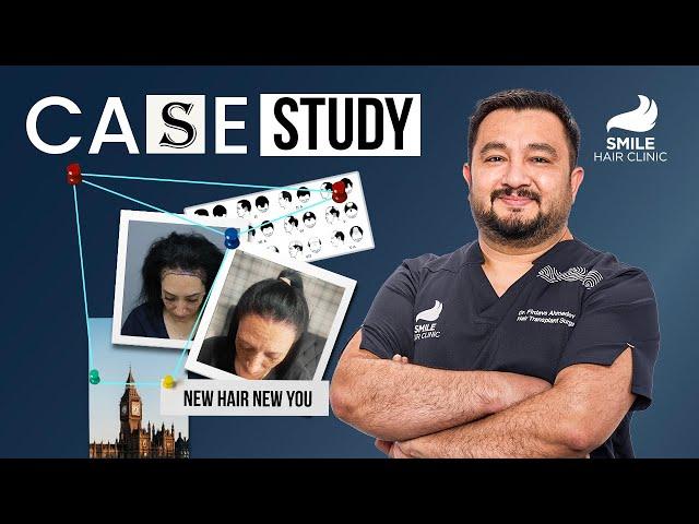 Women Hair Transplant Case Study | 3200 Grafts | Dr. Firdavs Ahmedov | Smile Hair Clinic