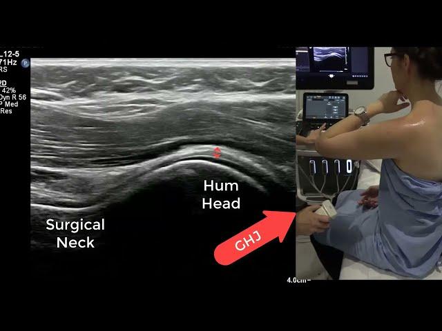 Ultrasound Shoulder - tips for successful rotator cuff and inferior glenohumeral ligament imaging.