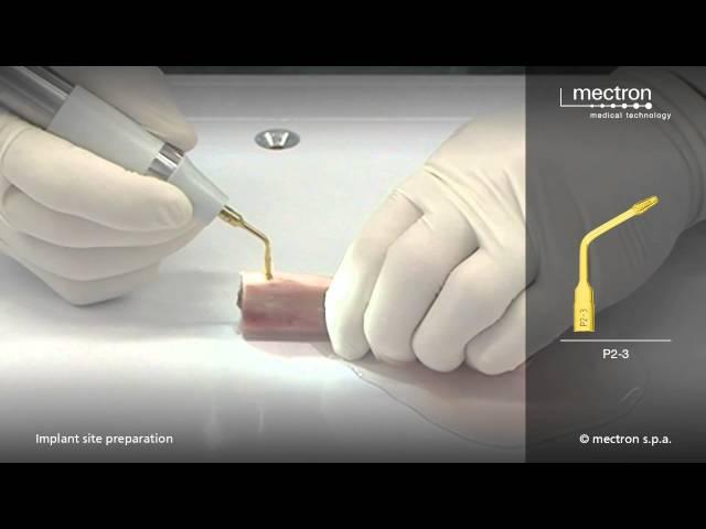 PIEZOSURGERY - HANDS-ON - Implant site preparation