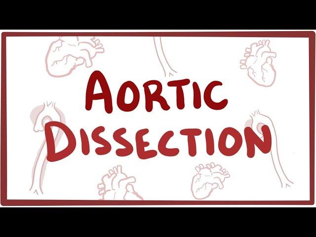 Aortic Dissection - causes, symptoms, diagnosis, treatment, pathology