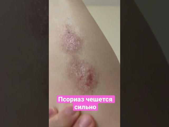 #psoriasis #псориаз Сильно чешется псориаз что делать