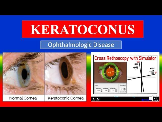 KERATOCONUS - Definition, types, causes, pathophysiology, symptoms , diagnoses , medicine