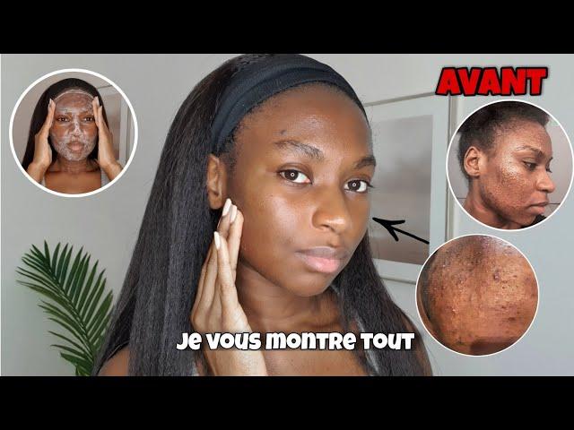 SKINCARE ROUTINE SIMPLE CONTRE LES BOUTONS ET LES TÂCHES  | ACNE SKINCARE ROUTINE