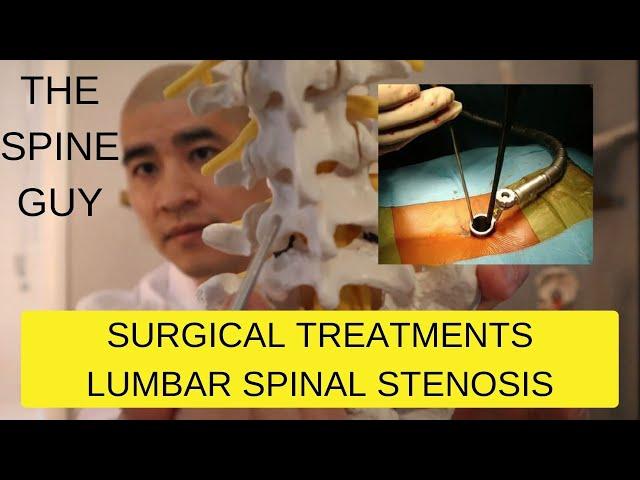 Part 3 - Surgical Treatments for Lumbar Spinal Stenosis