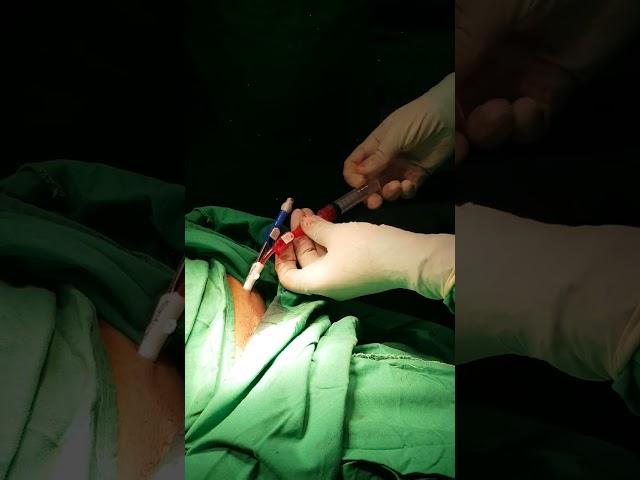 PermaCath for Dialysis Patients