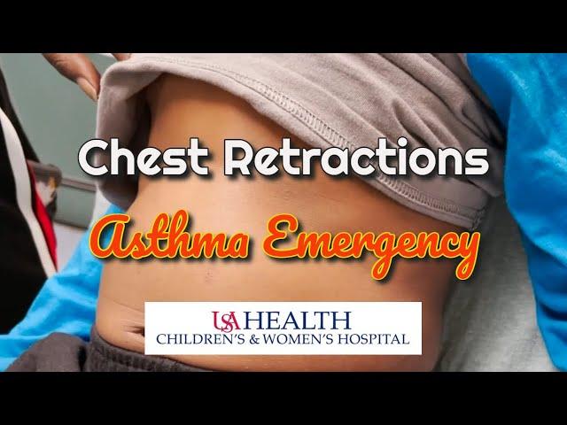 Chest Retractions in a Severe Asthma Attack