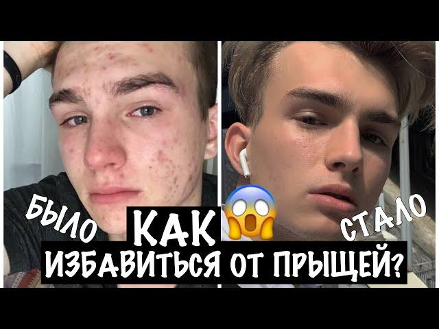 КАК ИЗБАВИТЬСЯ ОТ ПРЫЩЕЙ? | плюс мой уход за кожей и волосами