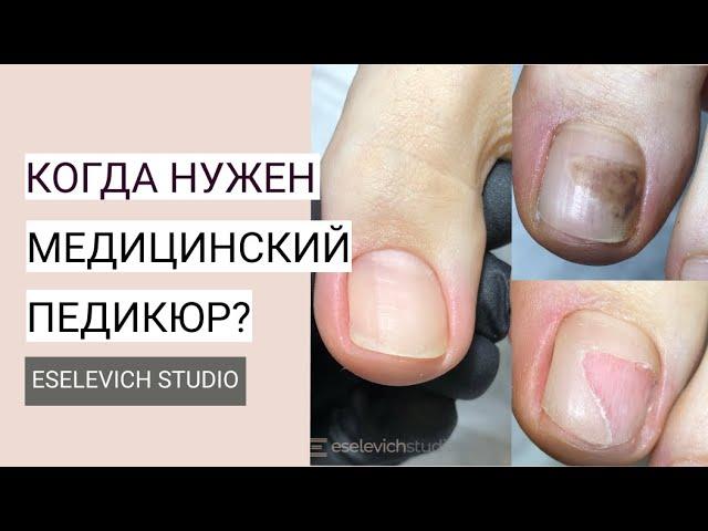 Медицинский Педикюр. Какие Проблемы Ног и Ногтей Может Решить Медицинский Педикюр?